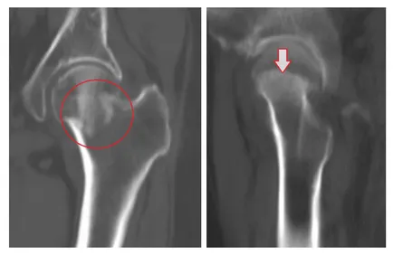 Diagnosticul radiologic al fracturilor de femur, un al doilea aviz