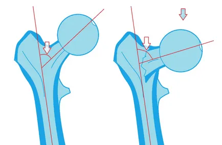 Diagnosticul radiologic al fracturilor de femur, un al doilea aviz