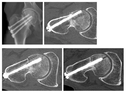 Diagnosticul radiologic al fracturilor de femur, un al doilea aviz