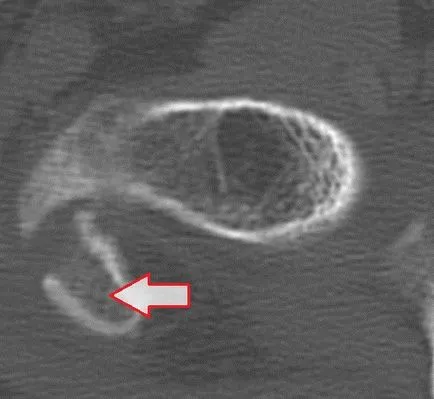 Diagnosticul radiologic al fracturilor de femur, un al doilea aviz