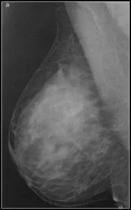 Mamografia este norma, chist, cancer, boli de sân în imagini, un al doilea aviz