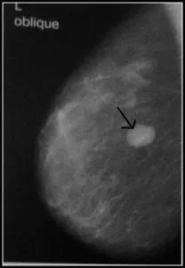 Mamografia este norma, chist, cancer, boli de sân în imagini, un al doilea aviz