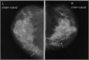 Mamografia este norma, chist, cancer, boli de sân în imagini, un al doilea aviz