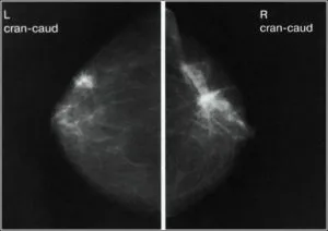 Mamografia este norma, chist, cancer, boli de sân în imagini, un al doilea aviz