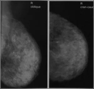 Mamografia este norma, chist, cancer, boli de sân în imagini, un al doilea aviz