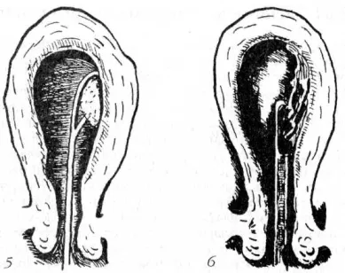 chirurgie mici interventii chirurgicale ginecologice pe organele genitale externe, vagin