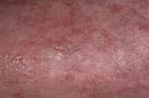 Ulei de eczeme - tipuri, eficiență, metode de aplicare