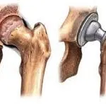 Arthroplasty térdizületek, csípő