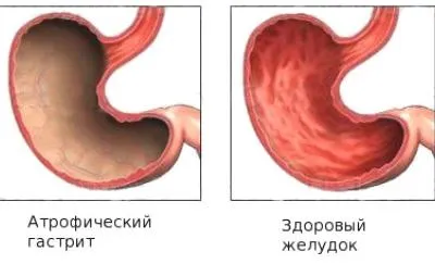 Атрофичен гастрит симптоми и причини за