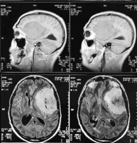 meningiom cerebral - fara chirurgie si chirurgie moderne pentru a elimina