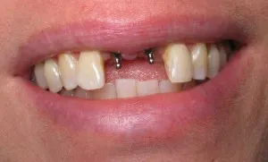 Microimplants в ортодонтия (протези мини импланти)
