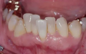 Microimplants in ortodontie (protetică mini implante)