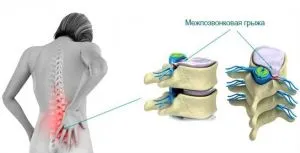 Este posibil să masaj caracteristicile coloanei vertebrale hernie și normele