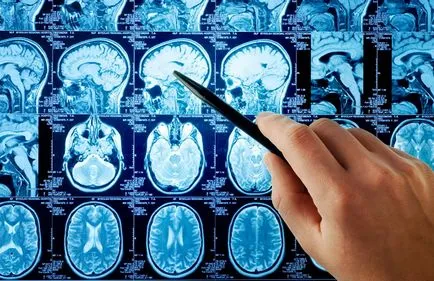 MRI stroke, hogy miért van szükség, hogy a felmérést