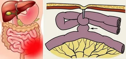 obstrucție intestinală mici cauze, simptome și tratament