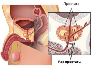 ujját vizsgálata a prosztata és műszeres módszerek