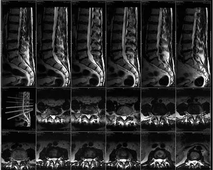 Általános információk az MRI a gerinc