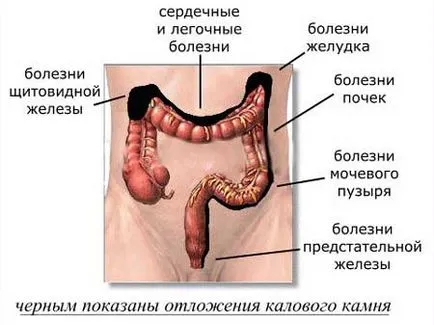 intestinale tratament - dacă este necesar pentru a curăța intestinele