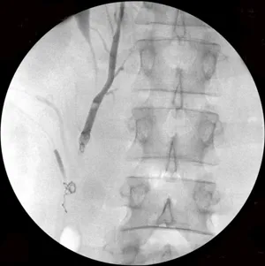 Működtetése varicocele - felkészülés opiratsii here varicocele ár