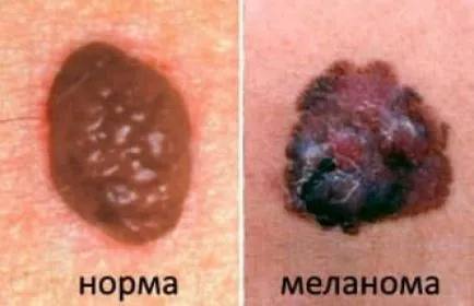 Onkológia vakondok képek és jelek a melanoma