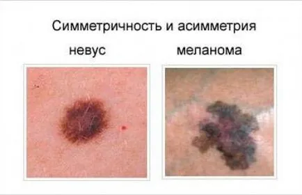 Onkológia vakondok képek és jelek a melanoma