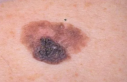 Onkológia vakondok képek és jelek a melanoma