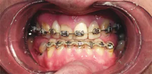 pregătire ortodontice pentru protezare - Ekaterinburg