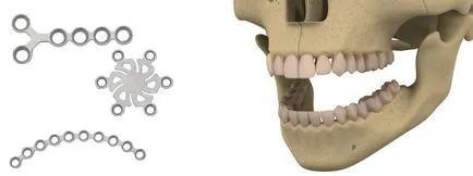 ortopédiai implantátumok