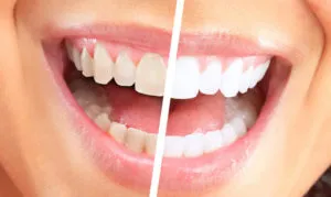 избелване на зъбите, за да отвъд - технологията, ползи, цена - д-р зъб