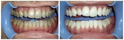 избелване на зъбите, за да отвъд - технологията, ползи, цена - д-р зъб