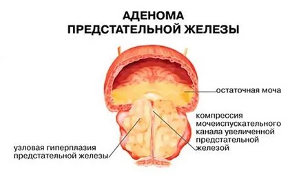 Codul de prostatita acuta si cronica in ICD 10