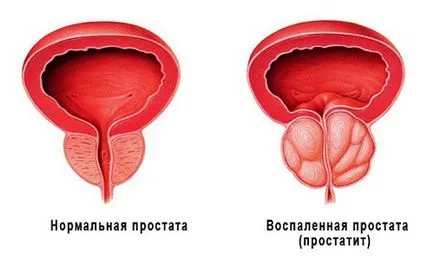 Codul de prostatita acuta si cronica in ICD 10