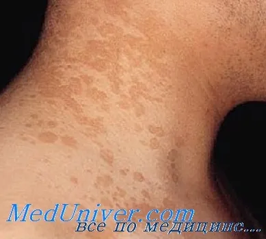 Pityriasis versicolor (pityriasis versicolor)