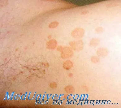 Pityriasis versicolor (pityriasis versicolor)