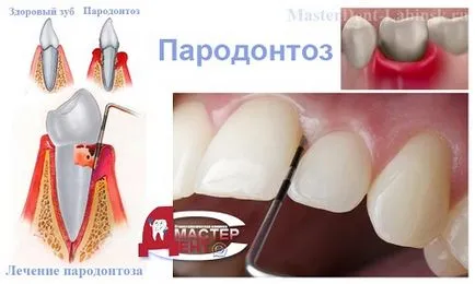 Periodontal лечение заболяване у дома (причини и симптоми)