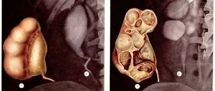 Pyelectasia бъбреците наляво и надясно, че е