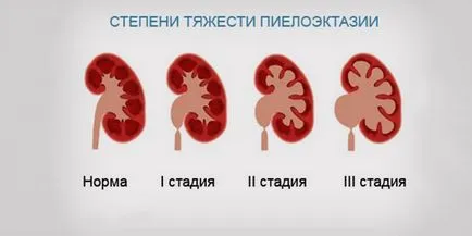 Pieloktaziya при новородените е разширение на CHLS на системата