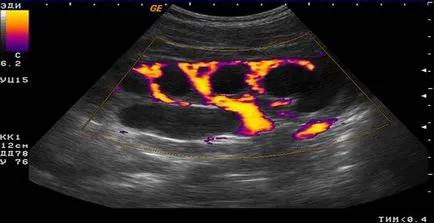 Pyelectasia бъбреците наляво и надясно, че е