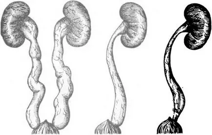 rinichii Pyelectasia dreapta și la stânga că este