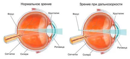 Как да се възстанови зрението в дългосрочен поглед в дома 1
