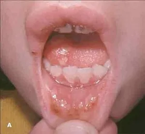 Care sunt cauzele ulcere la nivelul gurii cauze si tratament