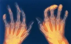 Arthritis az ízületek - mi ez okozza és típusú betegség