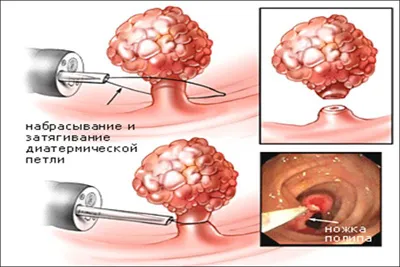 Simptomele polip cervical, tratament (modul de ștergere, consecințele), impactul asupra sarcinii