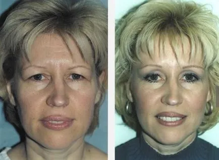 Brow lift, fotók, kilátás, ellenjavallatok, a kockázatok