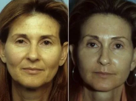 Brow lift, fotók, kilátás, ellenjavallatok, a kockázatok