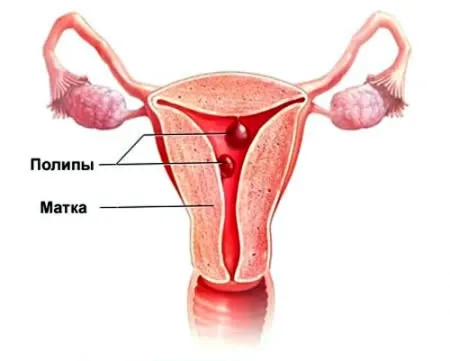 polip endometrial si sarcina