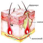 Има ли упражнение помощ с пъпната или ингвинална херния