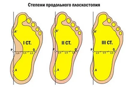 Странични и надлъжни плоски крака при деца и възрастни, симптоми и лечението