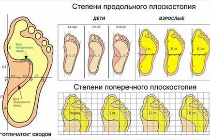 Keresztirányú és hosszirányú lúdtalp gyermekek és felnőttek, tünetei és kezelése