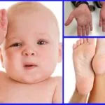 palmele transpirate și picioarele cauzelor copil, tratament, fotografie și video